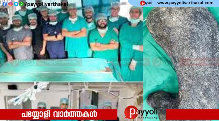 ഒരു മാസത്തിലേറെയായി വയറുവേദനയും ഛർദ്ദിയും;14 വയസുകാരിയുടെ വയറ്റിൽ നിന്ന് 210 സെന്റീമീറ്റർ നീളമുള്ള മുടിക്കെട്ട്