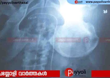 വയറുവേദനയെത്തുടർന്ന് ചികിത്സതേടിയപ്പോൾ കണ്ടെത്തിയത് രണ്ടുവർഷംമുൻപ്‌ വൃക്കയിലെ കല്ലുനീക്കാൻ  ശസ്ത്രക്രിയയിൽ ഘടിപ്പിച്ച ട്യൂബ്