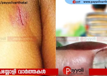 കൊടുവള്ളിയിൽ 12 കാരനെ മർദിച്ച സംഭവം; മുഖ്യപ്രതി വിദേശത്തേക്ക് കടന്നതായി സൂചന
