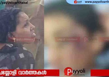 ഫോണിൽ നിന്ന് വാട്സാപ്പ് ഡിലീറ്റ് ചെയ്തതിന്റെ പേരിൽ  ആറുവയസുകാരിയുടെ മുഖം  അമ്മ തല്ലിച്ചതച്ചു
